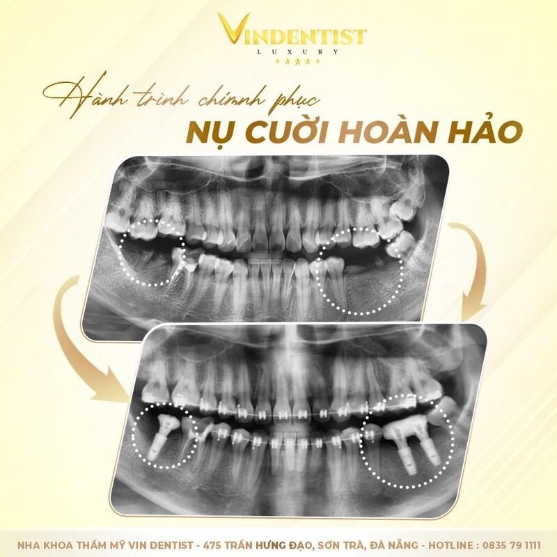 Trồng răng implant phù hợp trong nhiều trường hợp đặc biệt