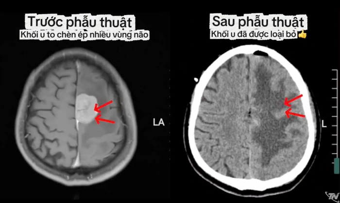 Phẫu thuật thành công u màng não liềm não bằng kỹ thuật vi phẫu hiện đại