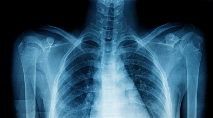 Nghiên cứu cho thấy khi ô nhiễm tăng lên, mật độ khoáng chất trong xương giảm xuống ở tất cả các vùng xương trong cơ thể. Ảnh minh họa: Getty Images
