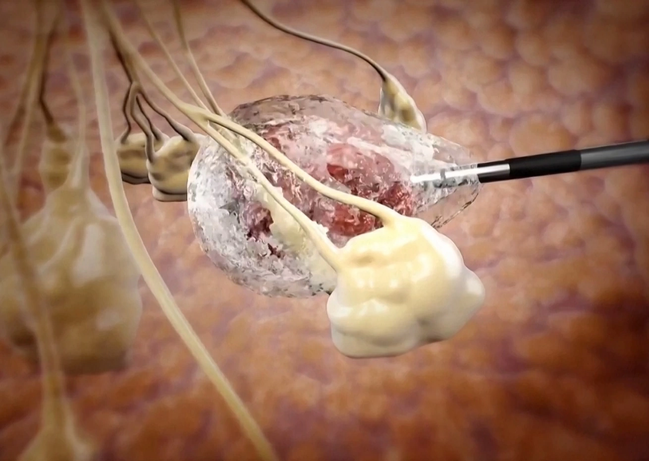 Liệu pháp áp lạnh (cryoablation), sử dụng nhiệt độ đóng băng để phá hủy mô khối u mà không cần cắt bỏ một phần vú.