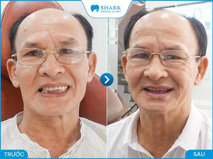 Hình ảnh khách hàng phục hình răng Implant tại nha khoa Shark