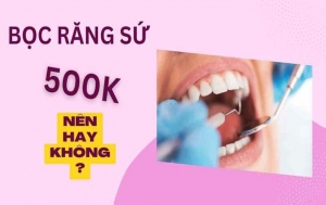 Bọc răng sứ 500k có nên hay không? Ưu đãi tại Nha khoa SGC