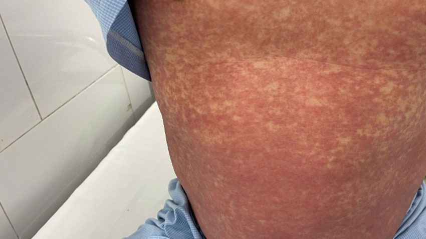 Hình ảnh người bệnh bị dị ứng với thuốc Phenylbutazone. Ảnh: nhandan.com.vn 