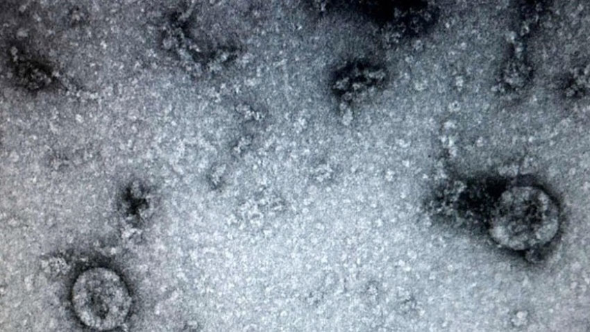 Các nhà nghiên cứu từ Đại học Y khoa Sechenov của Nga cảnh báo những người từng bị nhiễm virus SARS-CoV-2 đều có thể mắc một căn bệnh nguy hiểm: Hoại tử xương. (Ảnh: TTXVN)