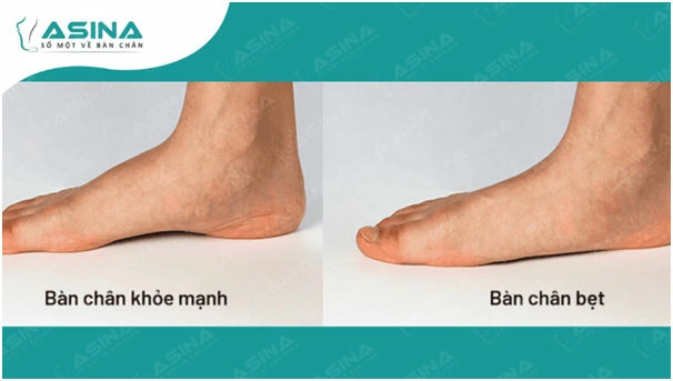 Sự khác biệt giữa bàn chân bẹt và bàn chân khỏe mạnh.