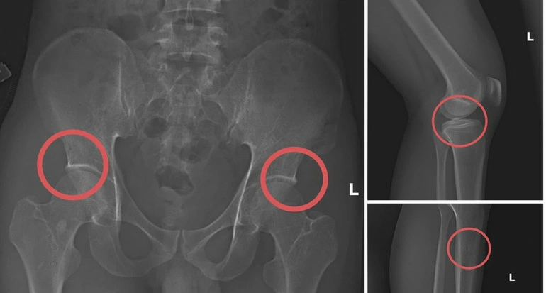 Bản phim chụp XQ một số tổn thương xương do đối tượng tạo ra nhằm trục lợi tiền bảo hiểm nhân thọ. Ảnh Báo Nhân dân