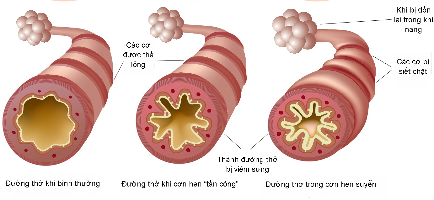 Phòng Ngừa Hen Phế Quản Mãn Tính