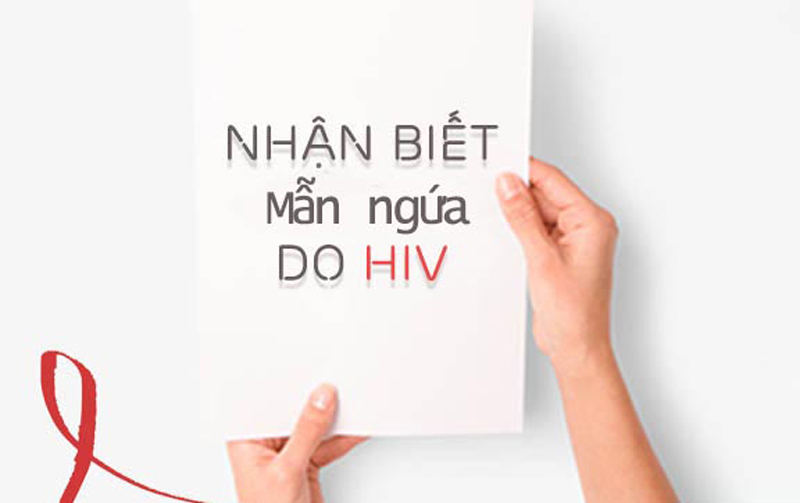 Nhận biết nổi mề đay do nhiễm virus HIV - Báo Thái Nguyên điện tử