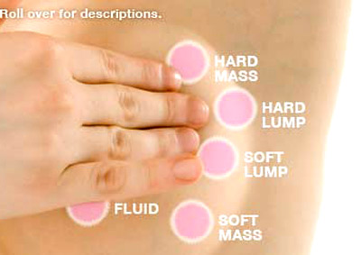 U vú chưa chắc đã là ung thư 